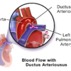 Farbzeichnung des Blutflusses von der Aorta in die Arteria pulmonalis bei offenem Ductus arteriosus Botalli