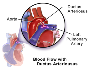 Farbzeichnung des Blutflusses von der Aorta in die Arteria pulmonalis bei offenem Ductus arteriosus Botalli
